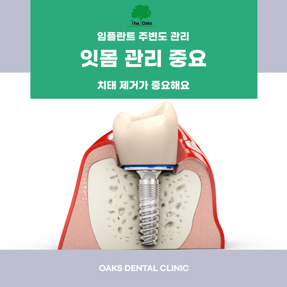 교대역치과 임플란트부작용 어떤 증상이 있을까요? 관련 이미지 3