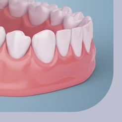 삼성동치과 건강보험임플란트 부담을 줄이며 치아 기능을 회복하는 방법 관련 이미지 16
