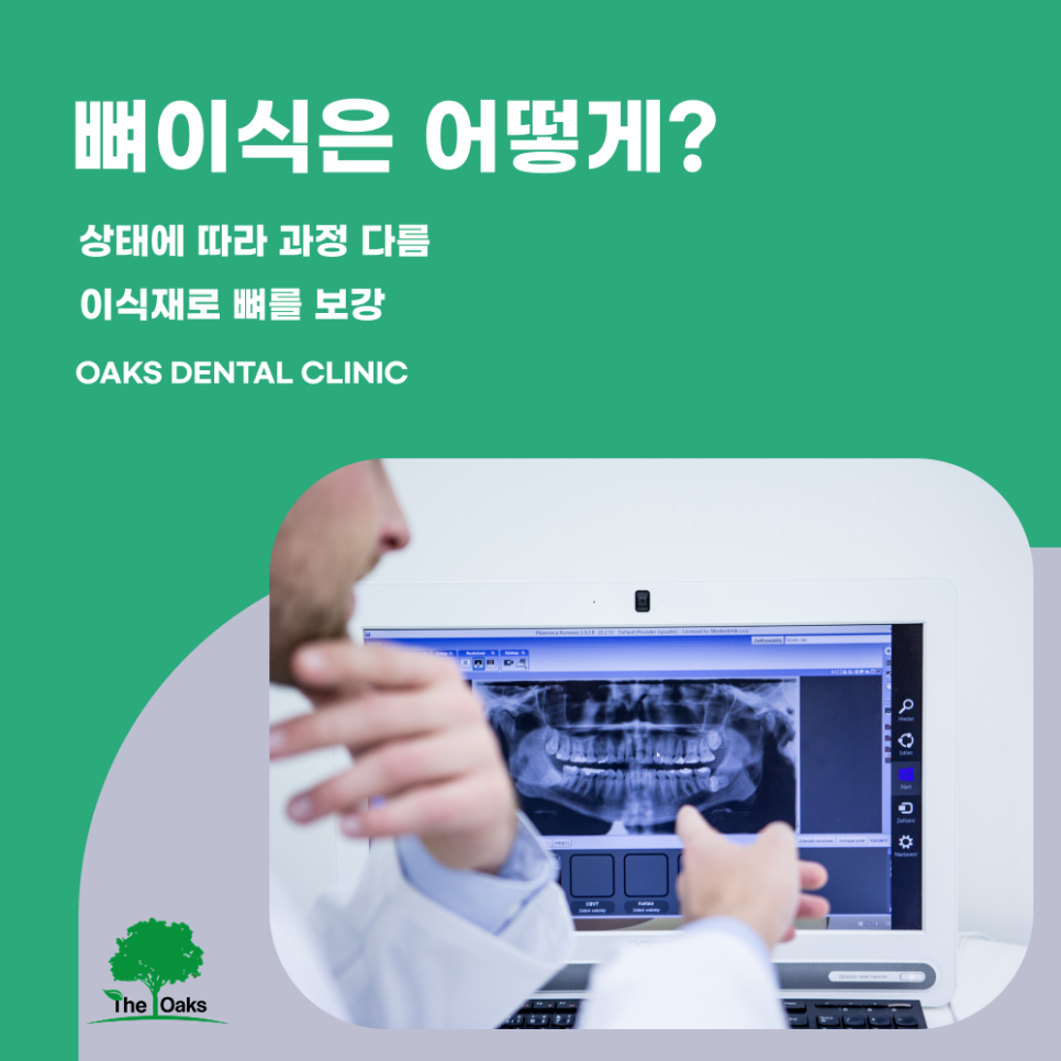 신사동치과 임플란트뼈이식 필요한 이유와 치료 전 확인해야 할 사항 관련 이미지 4