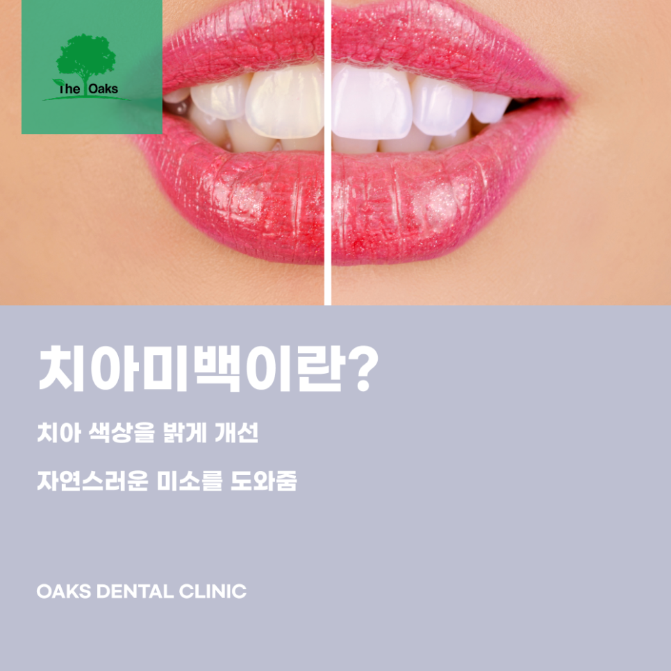 Daechi-dong Dental Clinic: Teeth Whitening Effects and Process, Helpful Information to Know Before Treatment image 1
