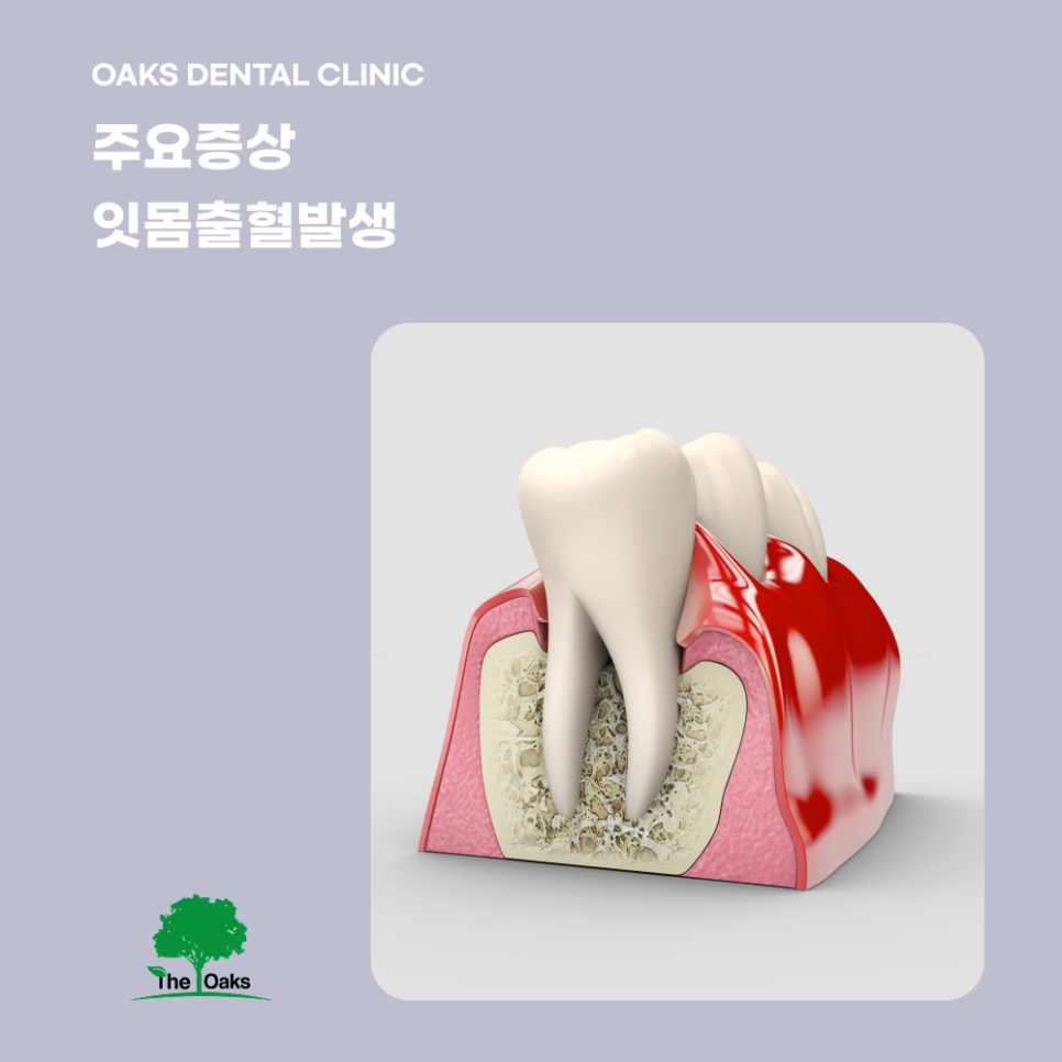 청담동치과 치주염증상 방치하면 치아 건강이 흔들립니다 관련 이미지 2