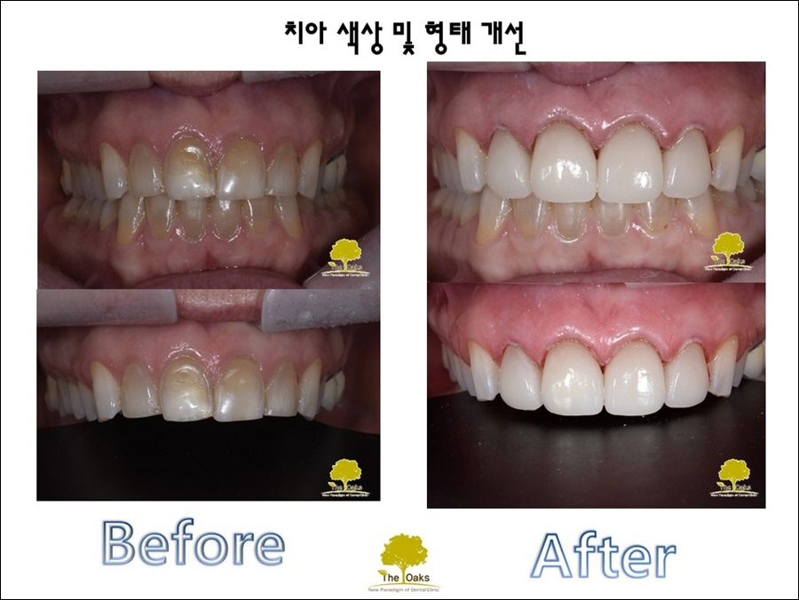 강남라미네이트 환하고 가지런한 치열 관련 이미지 1