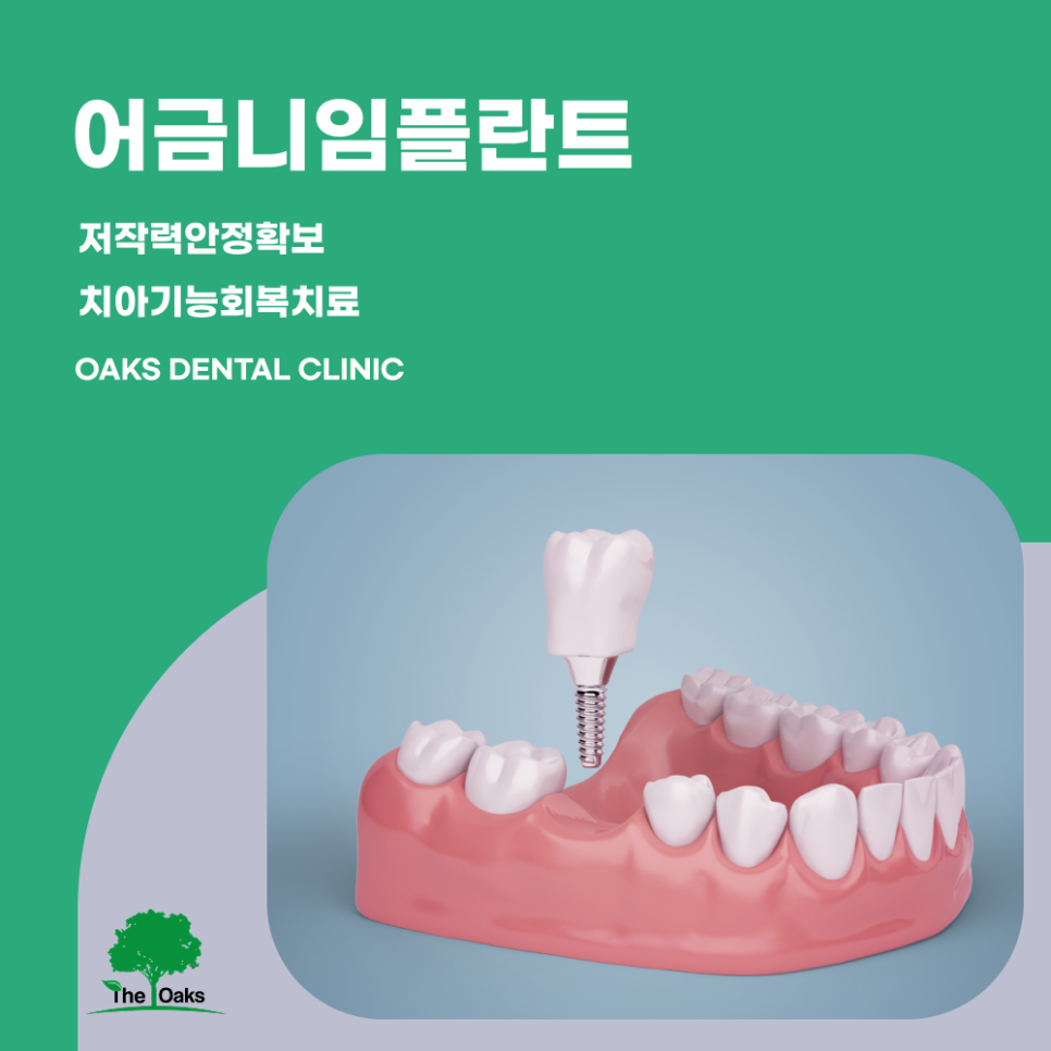 신사동치과 어금니임플란트 저작 기능 회복을 위한 안정적인 선택 관련 이미지 1