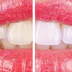 Daechi-dong Dental Clinic: Teeth Whitening Effects and Process, Helpful Information to Know Before Treatment image 9