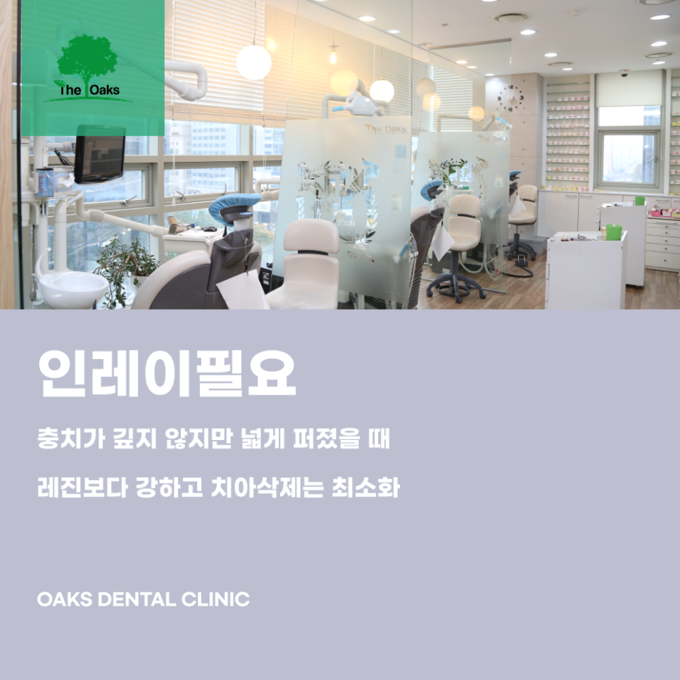 Minimize Tooth Damage and Restore a Natural Appearance with Inlay Treatment at a Samsung-dong Dental Clinic image 2