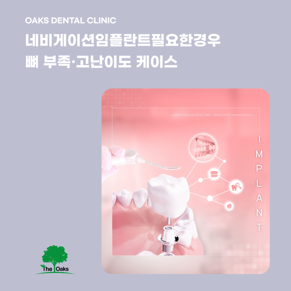 강남치과 네비게이션임플란트 더 안전하고 정확한 선택 관련 이미지 4