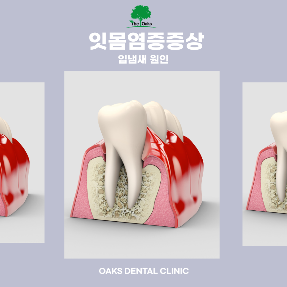 압구정동치과 잇몸염증치료 미루면 안 되는 이유와 건강한 잇몸 관리 방법 관련 이미지 3