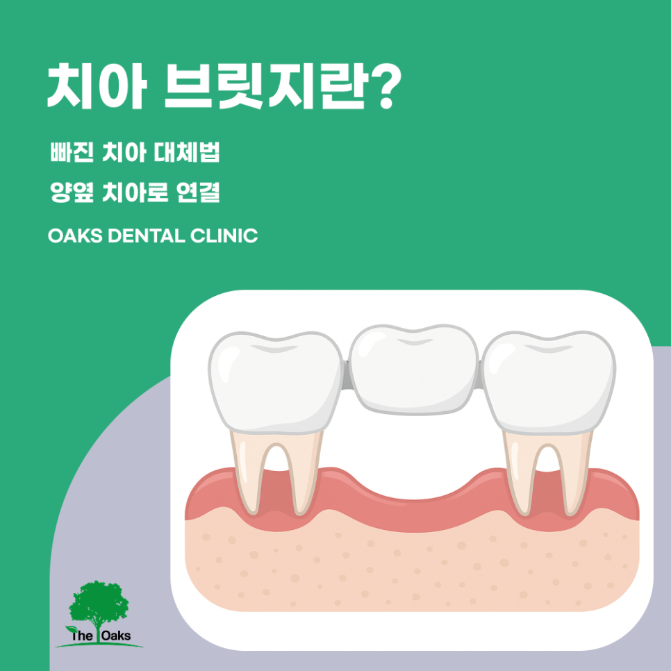 대치동치과 치아브릿지 어떤 상황에 도움될까 관련 이미지 1