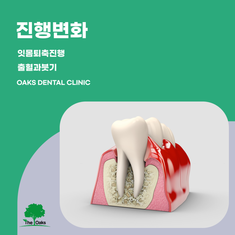 강남역치과 잇몸염증 가볍게 넘기면 안 되는 초기 신호 관련 이미지 2