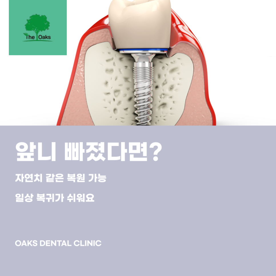 강남치과 앞니임플란트 기능과 심미 모두 잡을 수 있을까 관련 이미지 2