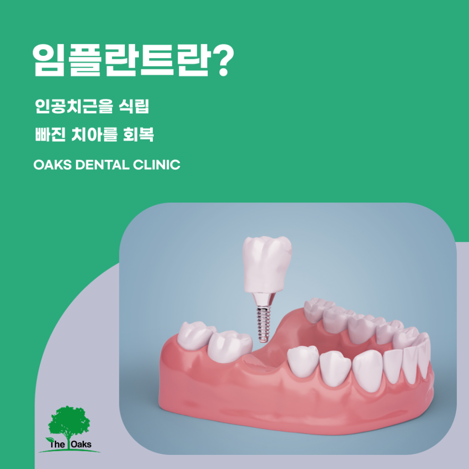 도곡동치과 임플란트종류 나에게 맞는 방법은? 관련 이미지 1