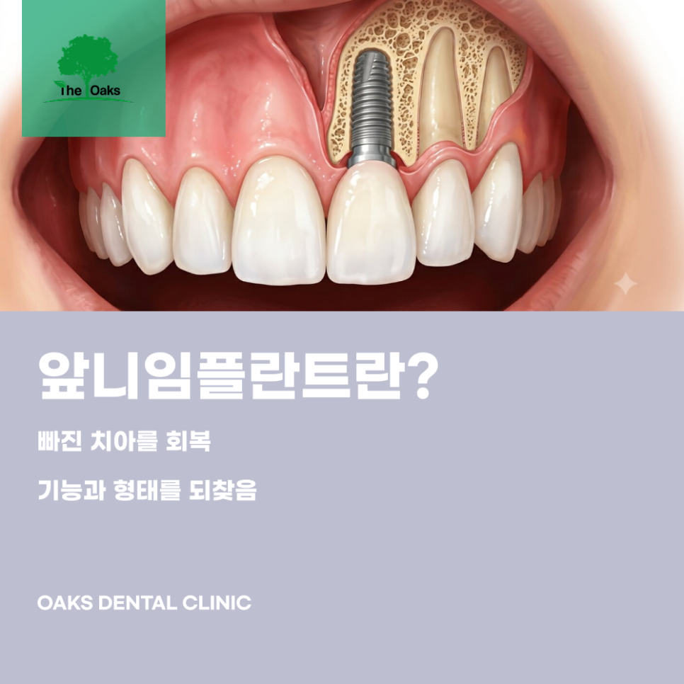 삼성동치과 앞니임플란트 자연스러운 결과를 위해 중요한 것 관련 이미지 1