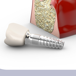 세곡동치과 뼈이식임플란트 부족한 잇몸뼈를 보완해 성공률을 높이는 방법 관련 이미지 15