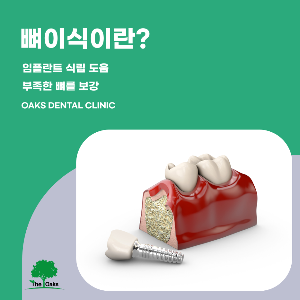 강남치과 뼈이식임플란트 꼭 필요한 경우는? 관련 이미지 1