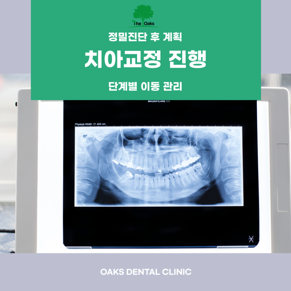 압구정동치과 치아교정 단순한 미용이 아닌 삶의 균형을 되찾는 과정 관련 이미지 3