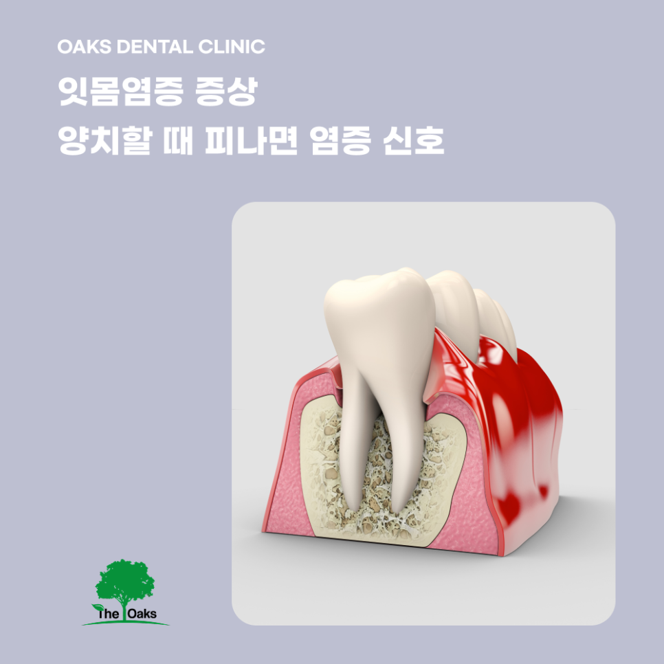 역삼동치과 잇몸염증 방치하면 치아 손실로 이어집니다 관련 이미지 3