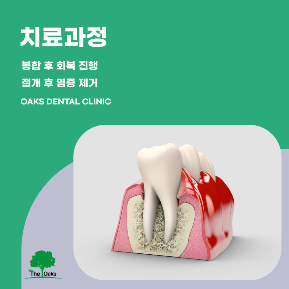 교대역치과 치근단절제술 신경치료로 해결되지 않을 때 선택하는 치료 방법 관련 이미지 3