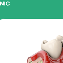 세곡동치과 뼈이식임플란트 부족한 잇몸뼈를 보완해 성공률을 높이는 방법 관련 이미지 12