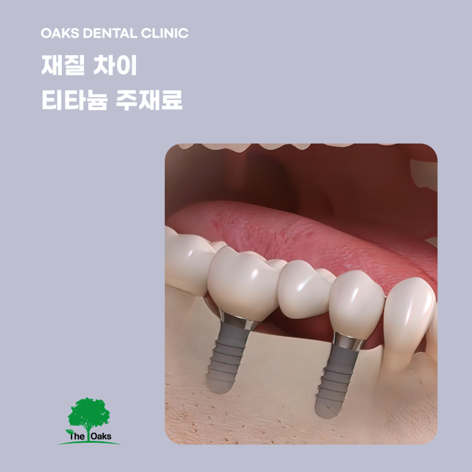 개포동치과 임플란트종류 나에게 맞는 선택이 중요한 이유 관련 이미지 2