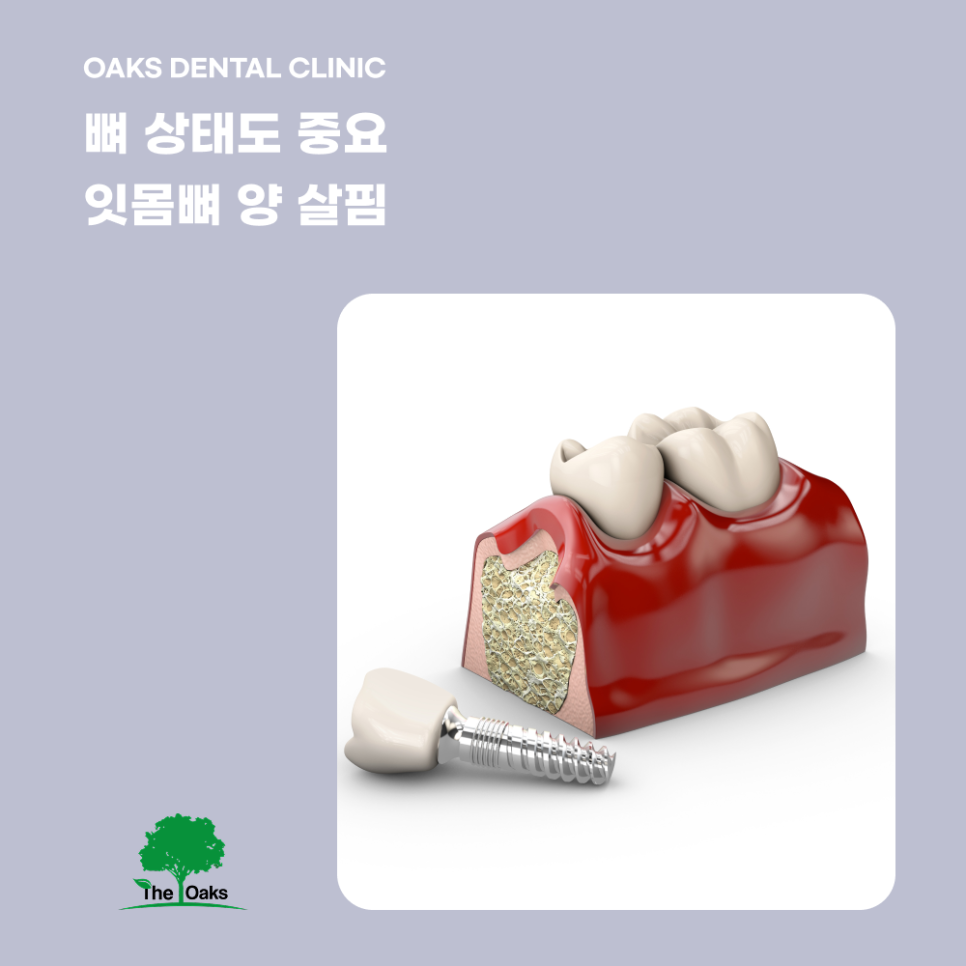강남구치과 임플란트식립은 어떻게 할까요? 관련 이미지 3