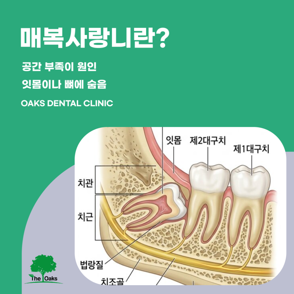 청담동치과 매복사랑니는 왜 발치할까요? 관련 이미지 1