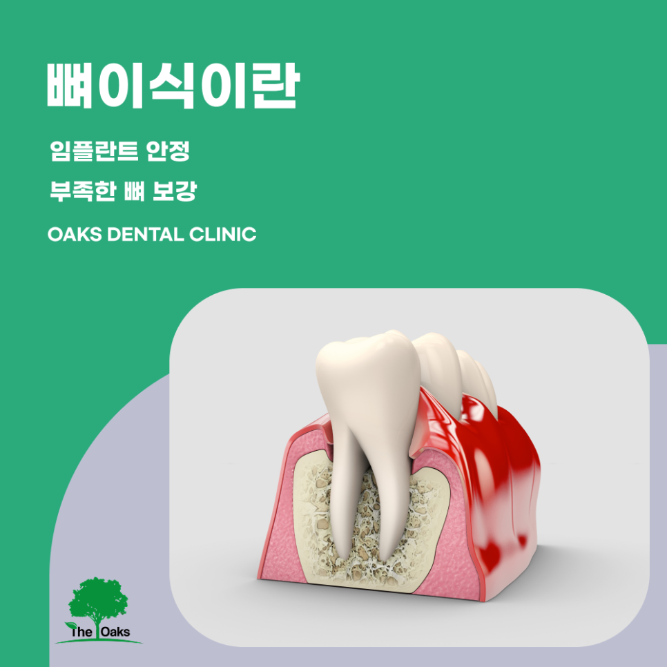 세곡동치과 뼈이식임플란트 부족한 잇몸뼈를 보완해 성공률을 높이는 방법 관련 이미지 1