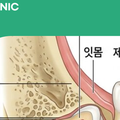 청담동치과 매복사랑니는 왜 발치할까요? 관련 이미지 12