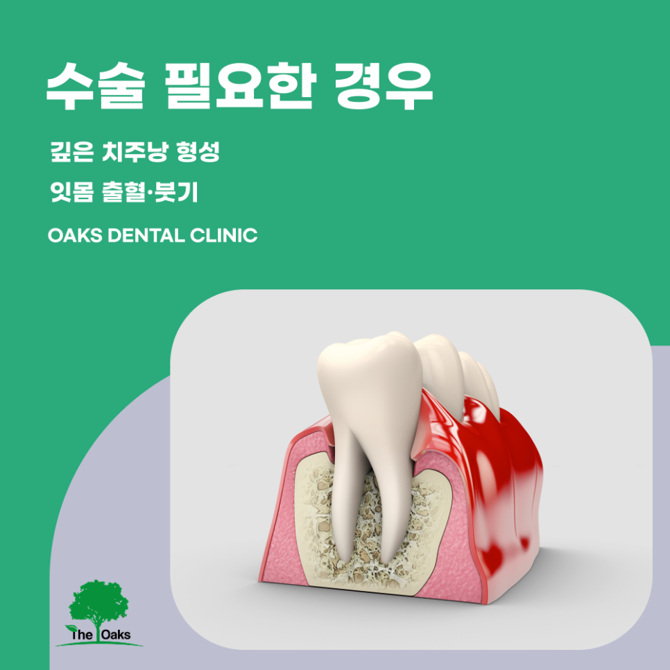 압구정동치과 치주수술로 잇몸 염증을 개선하고 치아를 오래 지키는 방법 관련 이미지 2