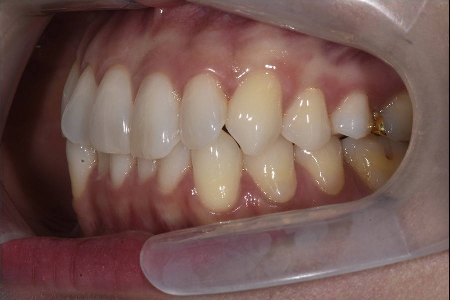 강남역치아교정 마스크 당당히 벗어요! 관련 이미지 3