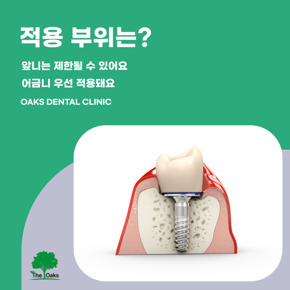 개포동치과 65세임플란트 건강보험으로 부담 줄이세요 관련 이미지 3