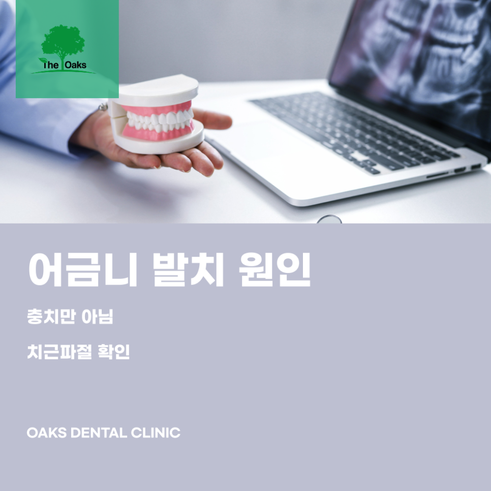 압구정동치과 어금니발치 치아를 살릴 수 없을 때 고려하는 치료입니다 관련 이미지 2