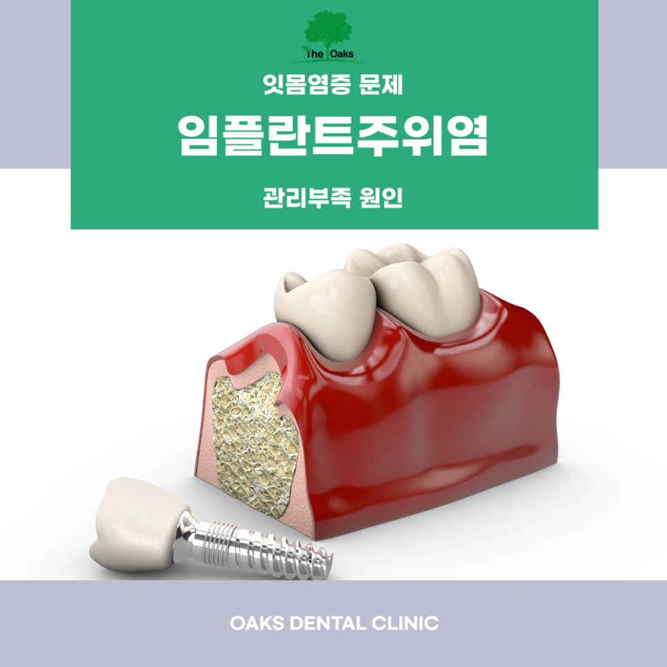 신사동치과 임플란트부작용 미리 알수록 예방할 수 있습니다 관련 이미지 3