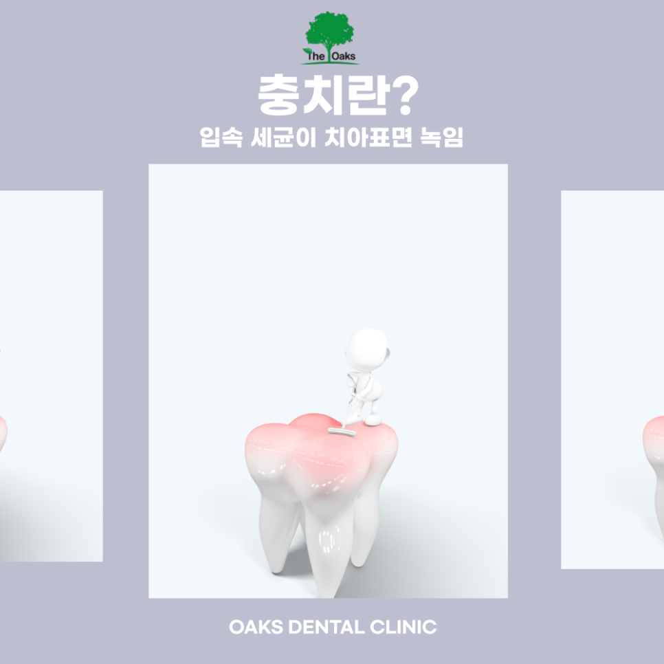 논현동치과 충치치료 아플 때가 아니라 생기기 전에 시작하세요 관련 이미지 2