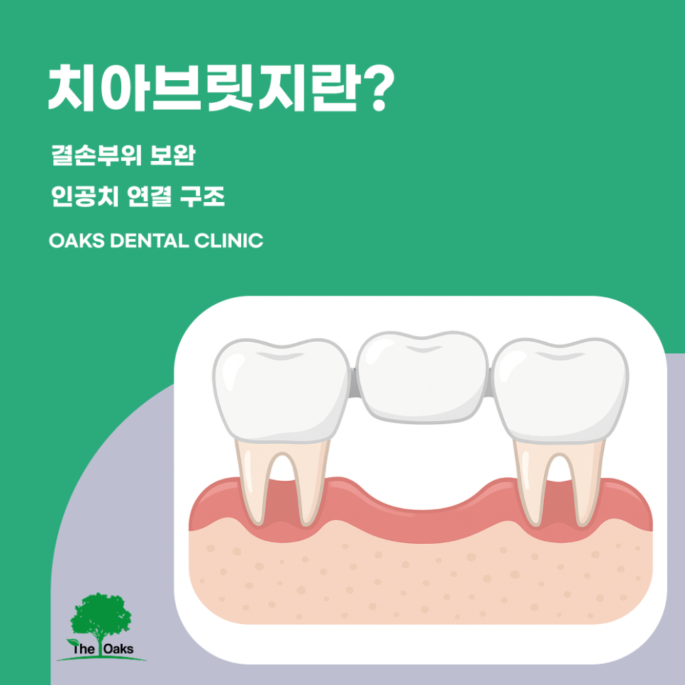 강남치과 치아브릿지 빠르고 안정적인 결손치 치료 방법 관련 이미지 1