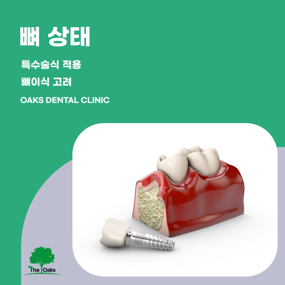 개포동치과 임플란트종류 나에게 맞는 선택이 중요한 이유 관련 이미지 4