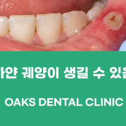 압구정동치과 구내염이 생겼을 때 알아두면 좋은 관리법 관련 이미지 15