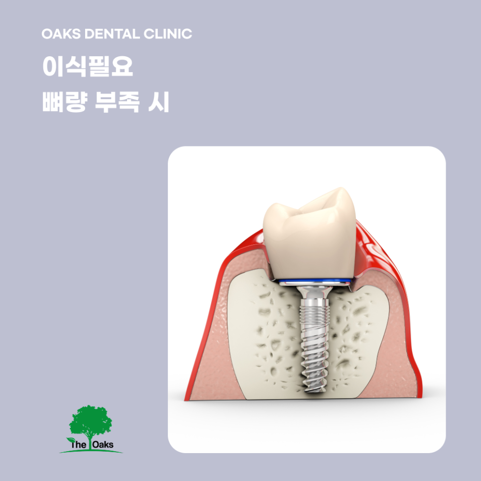 세곡동치과 뼈이식임플란트 부족한 잇몸뼈를 보완해 성공률을 높이는 방법 관련 이미지 3