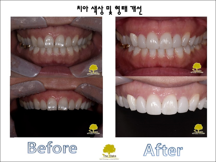 강남라미네이트가격 더 예뻐질 나를 위해 관련 이미지 2