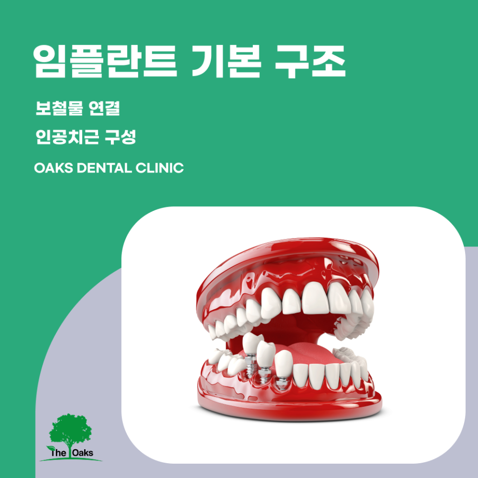 개포동치과 임플란트종류 나에게 맞는 선택이 중요한 이유 관련 이미지 1