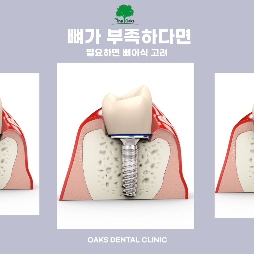 도곡동치과 임플란트종류 나에게 맞는 방법은? 관련 이미지 4