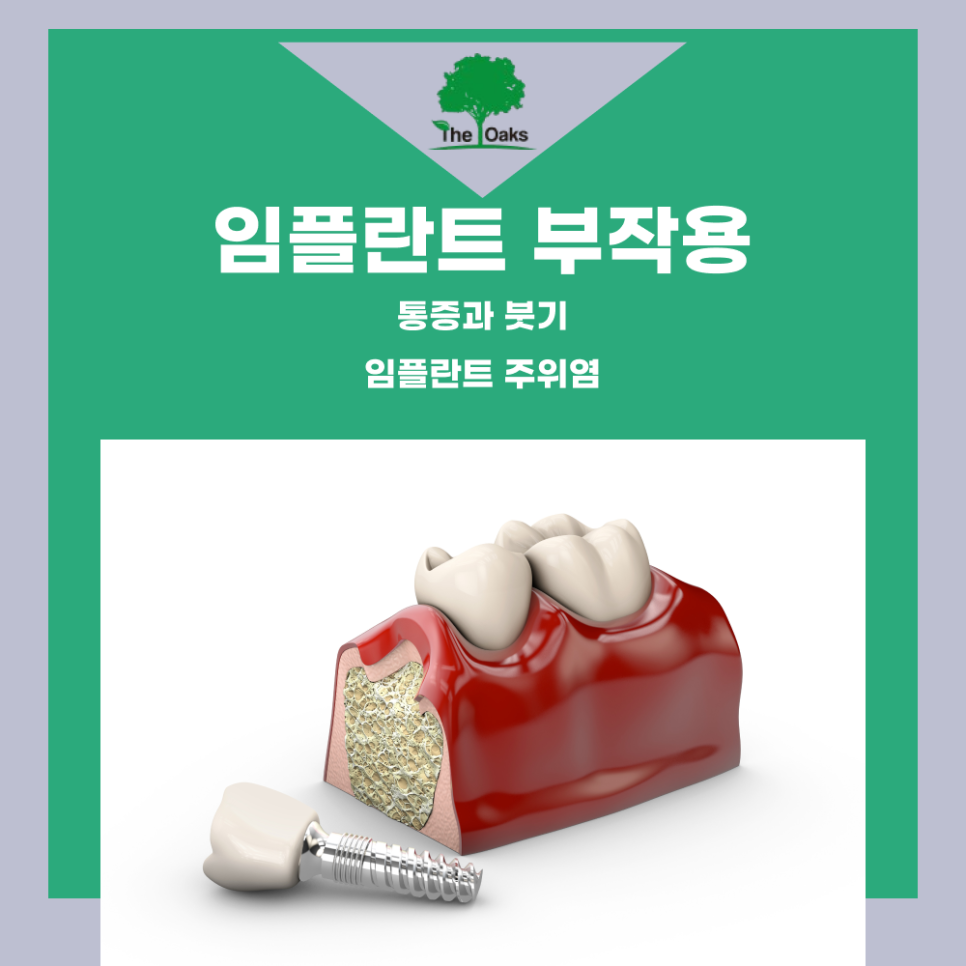 자곡동치과 임플란트부작용 알고 예방하면 걱정 없어요 관련 이미지 2