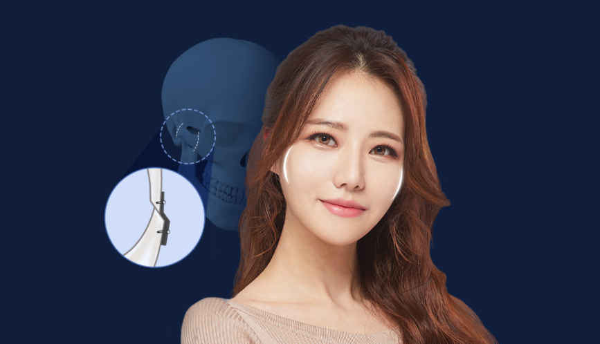 안면 윤곽 기술력의 집약 광대수술 관련 이미지 2