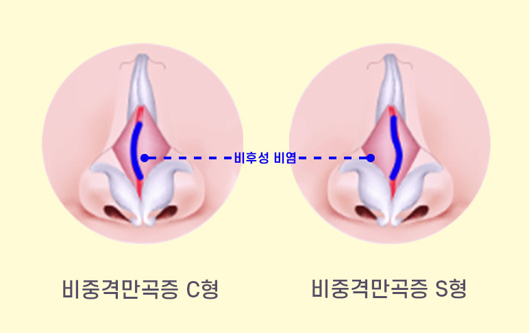 휘어진 콧대와 코 속을 한 번에 바로잡는 휜코 성형 관련 이미지 4