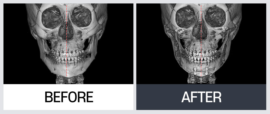 윤곽 재수술의 다양한 케이스와 수술 방법 관련 이미지 11