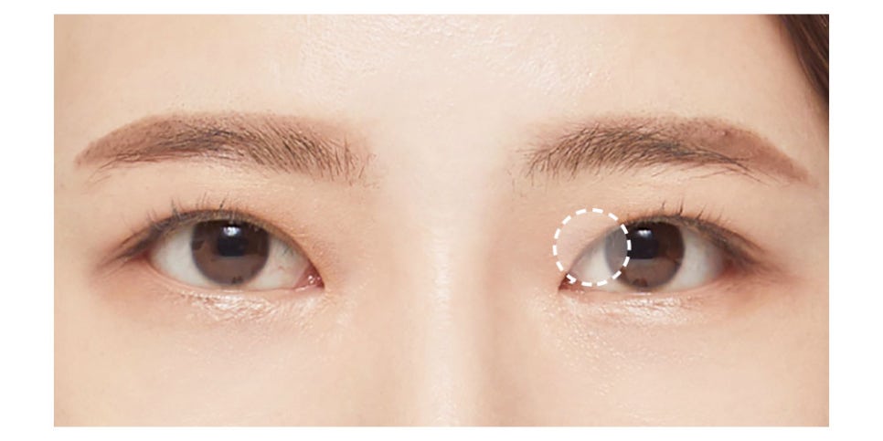 절개 쌍꺼풀, 원하는 라인으로 흉터 걱정 없이 한 번에 개선 관련 이미지 4