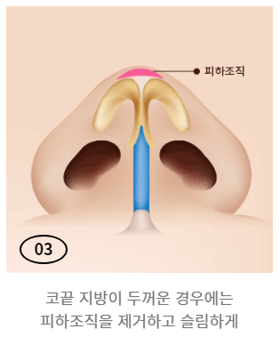 통통하고 뭉툭한 코, 슬림하고 오똑하게! 복코 성형 관련 이미지 5