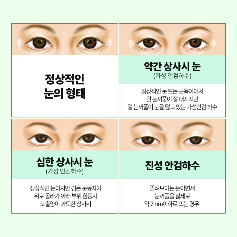 눈매교정만으로 매력적인 눈매를 만들 수 있습니다. 관련 이미지 2