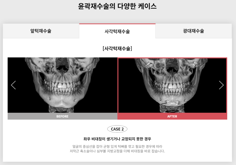 다시 되찾는 아름다운 미소! 윤곽재수술 관련 이미지 5