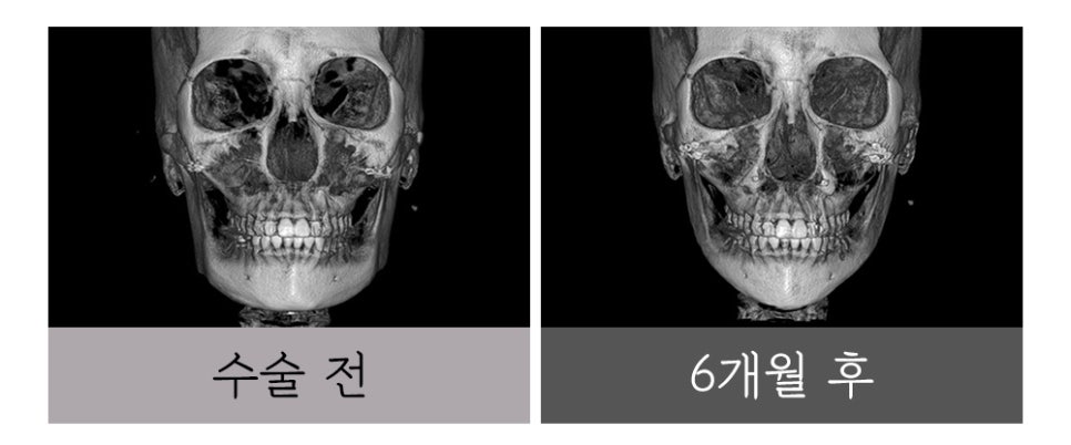윤곽 재수술, 정밀한 진단과 치밀한 설계로 바로잡아야 합니다. 관련 이미지 4