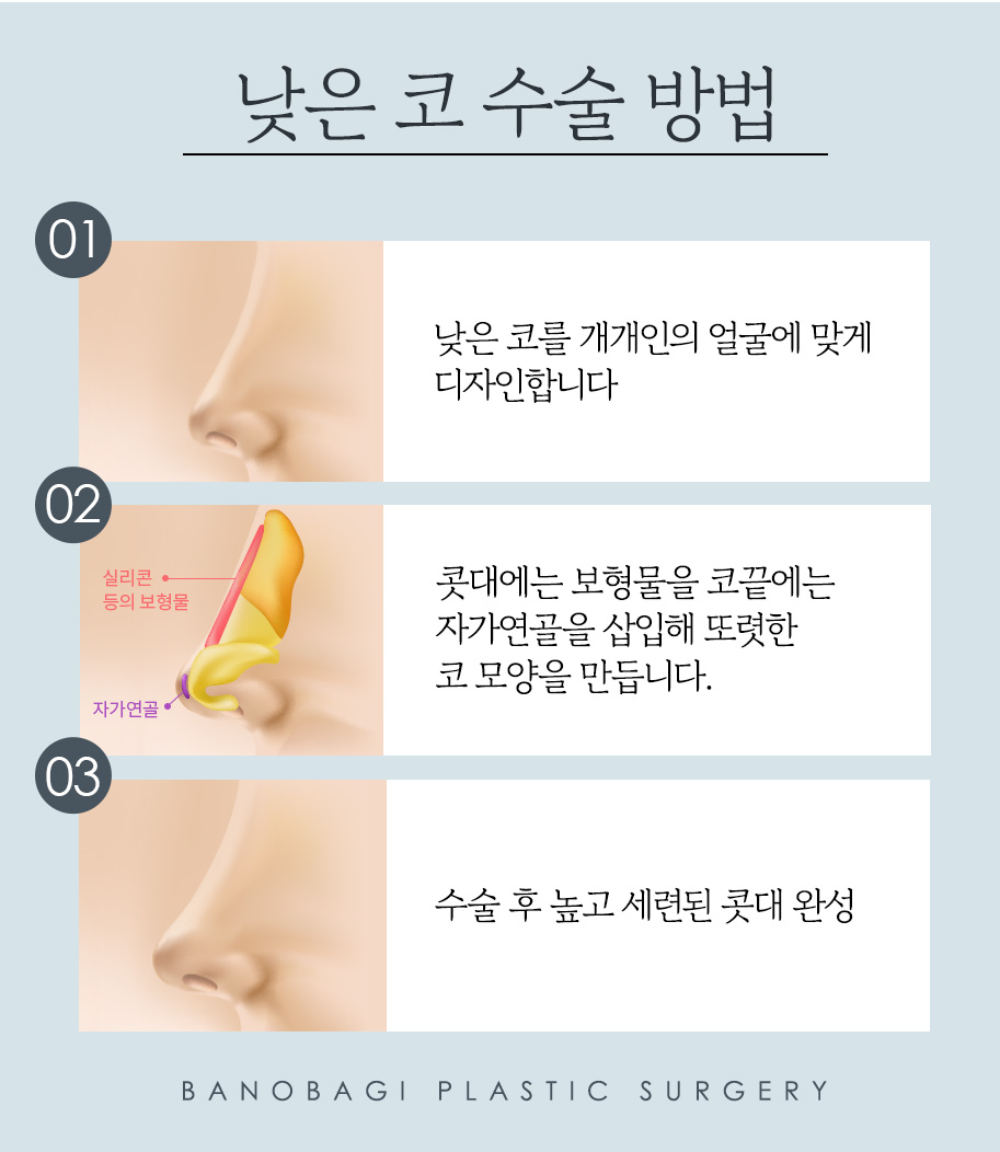 남자 코성형, 코 라인에 따라 달라지는 수술 방법 관련 이미지 4